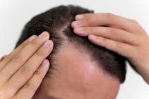 Hair regrowth in men