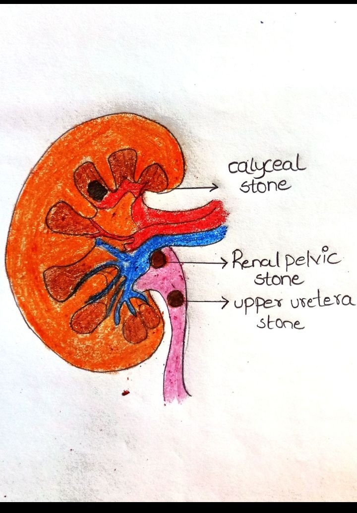 Kidney stone location