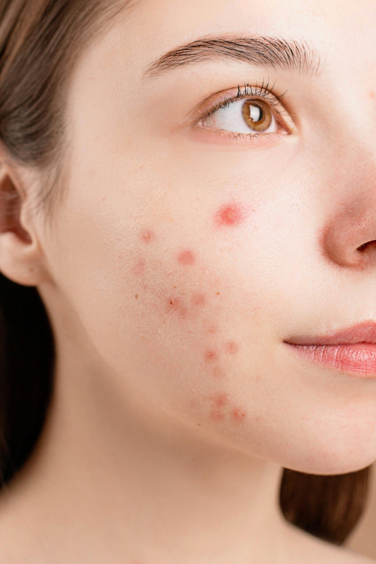 Acne face