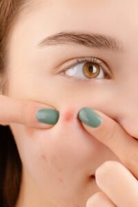 Teenage acne prevention