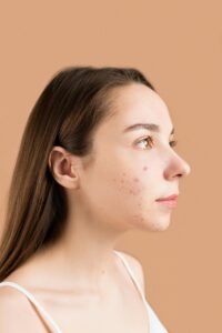 Acne on face