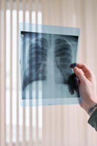 lungs are infected severly 